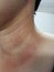 The skin around the neck is inflamed with redness, sunburn, close up, Asian women