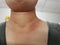 The skin around the neck is inflamed with redness, sunburn, close up, Asian women