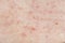 Skin background texture with pimples and blackheads. problematic skin close up. acne diseases