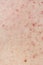 Skin background texture with pimples and blackheads. problematic skin close up. acne diseases