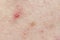 Skin background texture with pimples and blackheads. problematic skin close up. acne diseases