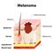 Skin cancer. Melanoma