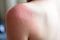 Skin care concept. Handsome guy got sunburn and got tan lines on his shoulder. The skin sloughs off its his burn skin. It is the