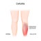 Skin cellulitis. Healthy leg, and leg with symptoms of Infectious disease