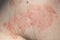 Skin dermatitis