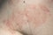 Skin dermatitis