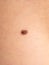 Skin disease. Closeup brown mole on caucasian human body.