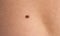 Skin disease. Closeup brown mole on caucasian human body.