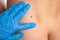Skin disease. Closeup brown mole on caucasian human body.