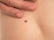 Skin disease. Closeup brown mole on caucasian human body.