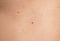 Skin disease. Closeup brown mole on caucasian human body.