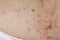 Skin disease prickly heat rash or miliaria on back skin of asian woman. Healthcare skin cause for outdoor work in sunny with hot