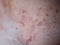 Skin disease prickly heat rash or miliaria on back skin of asian woman. Healthcare skin cause for outdoor work in sunny with hot