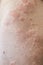 Skin imperfection. Skin allergy. Urticaria disease. Red spots on the skin.