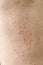 Skin imperfection. Skin allergy. Urticaria disease. Red spots on the skin.