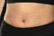 Skin indents from underwear on a woman`s belly