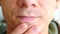 Skin irritation after shaving. Man scratching with his arm pimples on the chin. Closeup of nose, lips and chin