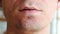 Skin irritation after shaving. Pimples on the man`s chin, closeup chin and lips.