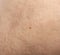 Skin mole closeup. Macro photo of blemish similar to melanoma