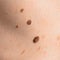 Skin mole on human body. Brown nevi or nevus on back skin. Check moles concept. Closeup