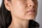 Skin problem with acne diseases, Close up of asian woman face with whitehead pimples, Menstruation breakout