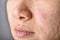 Skin problem with acne diseases, Close up woman face with acne marks and allergy red rash, Scar and oily greasy face