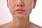 Skin problem with acne diseases, Close up woman face with whitehead pimples.