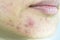 Skin problem with acne diseases, Close up woman face with whitehead pimples on chin.