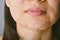 Skin problem with acne diseases, Close up woman face with whitehead pimples on chin