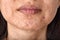 Skin problem with acne diseases, Close up woman face with whitehead pimples on chin, Menstruation breakout