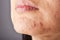 Skin problem with acne diseases, Close up woman face with whitehead pimples on chin, Menstruation breakout