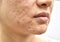 Skin problem with acne diseases, Close up woman face with whitehead pimples, Menstruation breakout, Scar and oily greasy face.