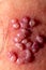 Skin rash and blisters on body. Shingles on men herpes zoster