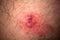 Skin rash and blisters on body. Shingles on men herpes zoster