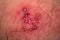 Skin rash and blisters on body. Shingles on men herpes zoster