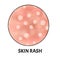 Skin rash. Symptom of dermatitis, allergies, psoriasis, eczema. Icons skin rash. Acne Infographics. Vector illustration