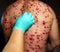 skin rash treatment on male body. Shingles, Disease, Herpes zoster, varicella-zoster virus