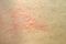 Skin rash, Urticaria, Allergic skin reaction.