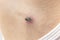 Skin tag mole darkened, scorched and dried up
