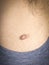 Skin tag mole sloseup before treatment