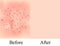 Skin texture with black dots of acne. Before After acne. Skin background. Infographics. Vector illustration
