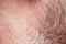 Skin texture of the neck and cheeks of a young man covered with hair and beard bristles and irritation and scales