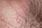 Skin texture of the neck and chin of a young man covered with hair and beard bristles and irritation and scales