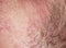 Skin texture of the neck and chin of a young man covered with hair and beard bristles and irritation and scales