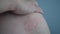 Skin texture suffering severe urticaria or hives or kaligata on shoulder