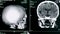 Skull model rotates on a screen, close up. Medical machine creates a model of a patient`s skull.