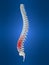 Slipped disc