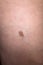 A small birthmark on human skin.