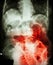 Small bowel obstruction