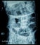 Small bowel obstruction ( film x-ray abdomen ( supine position ) : show small bowel and stomach dilate ) ( step ladder pattern )